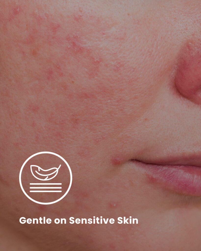 Sensitive Skin