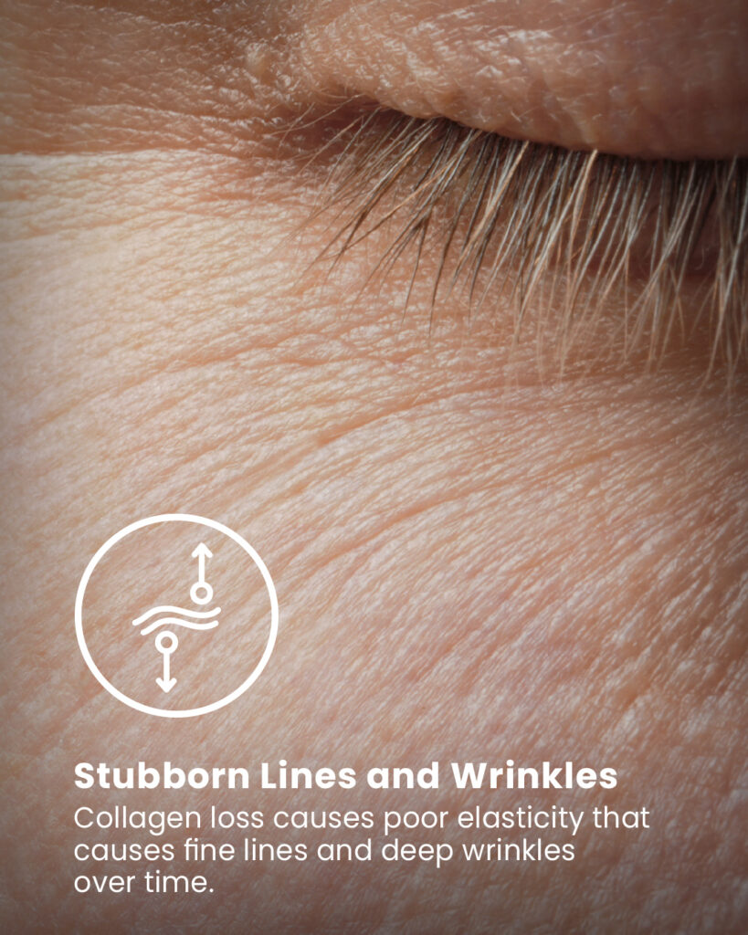 Stubborn Lines and Wrinkles